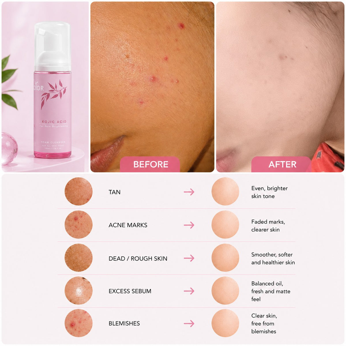 Orior Cosmetics Kojic Acid Foam Cleanser showing before and after results for acne marks, tan, and skin blemishes.